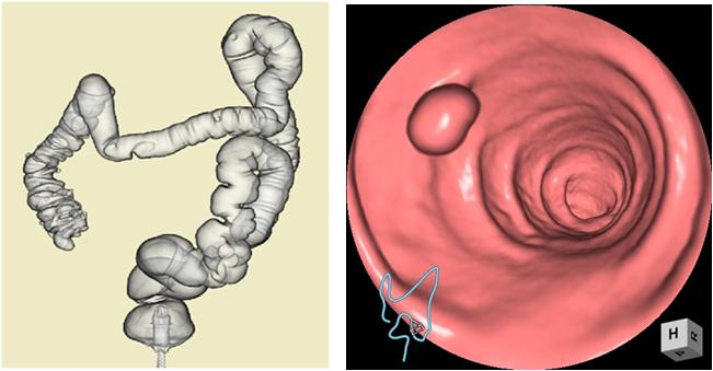 大腸CT検査 その2-東邦鎌谷病院